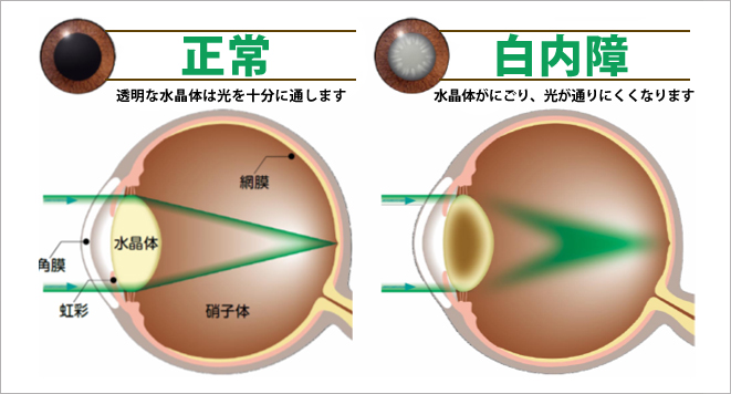 白内障｜花巻中央眼科